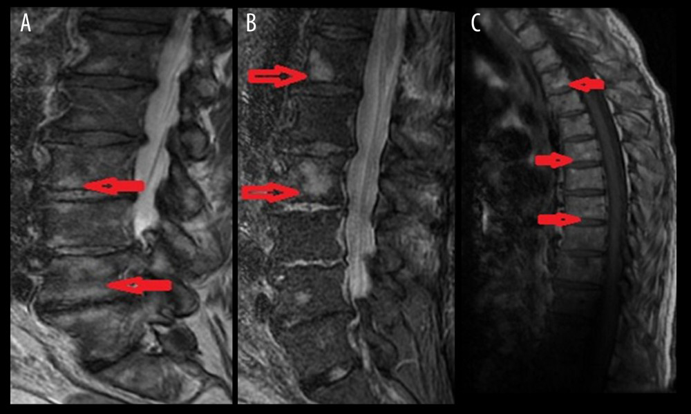 T2-weighetd magnetic resonance images of lumbar (A, B) and thoracic spine (C) showing multiple hyperintense-enhancing lesions in bodies of lumbar vertebrae (red arrows A, B) and thoracic vertebrae (red arrows in C), which were highly concerning of metastatic bone cancers or multiple myeloma.