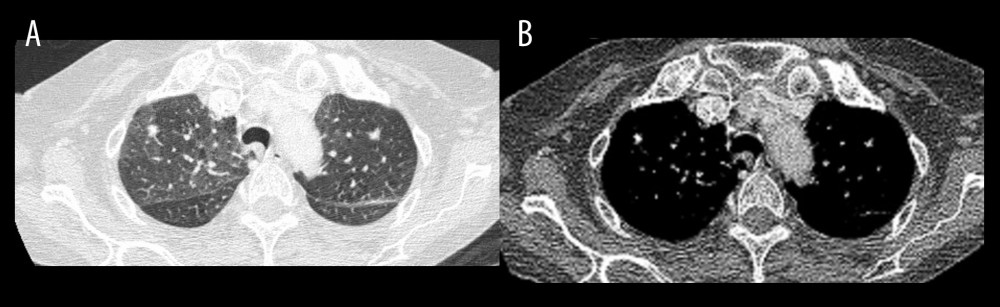 Computed tomography of the thorax with axial image (A) with mediastinal window (B) showing nodules in the upper lobes bilaterally.