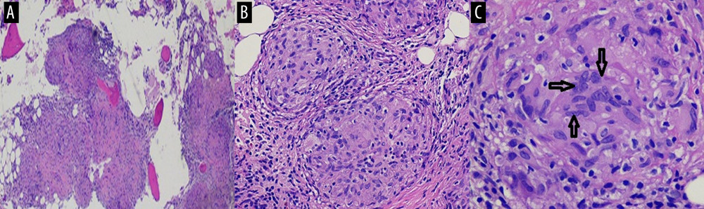 (A–C) Bone marrow biopsy (low 4×, high 10×, and objective immersion 40× magnifications of hematoxylin and eosin stained iliac bone marrow biopsy showing active non-caseating granulomatous inflammation consistent with osseous sarcoidosis. Multinucleated giant cells (small arrows in C).