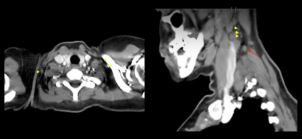 Contrast-enhanced CT-neck & thorax: Multiple, bilateral, enlarged deep cervical lymph nodes (arrow heads); the largest noted on the left side (arrow), measuring about 1.5×0.7 cm.
