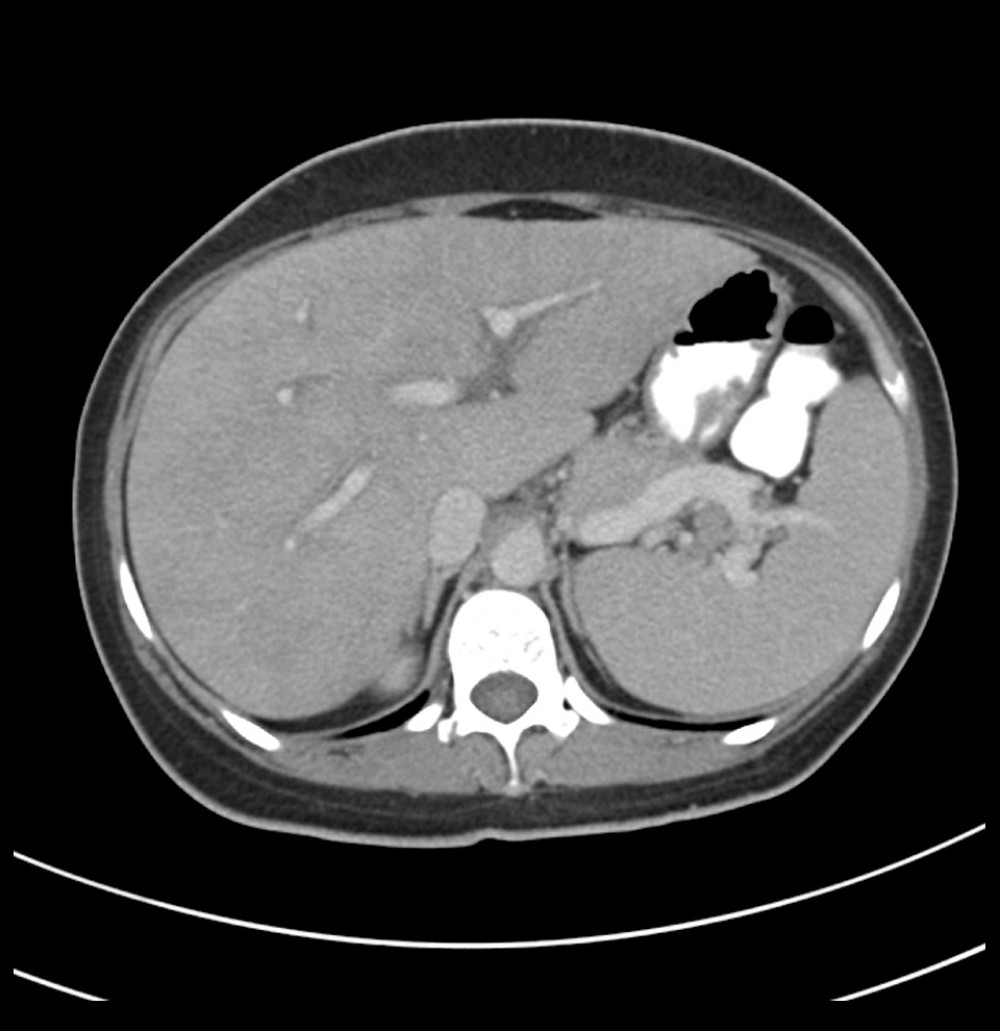Contrast-enhanced CT-Abdomen: showing enlarged liver, measuring about 22.5 cm along the long axis with heterogeneous nodular density.