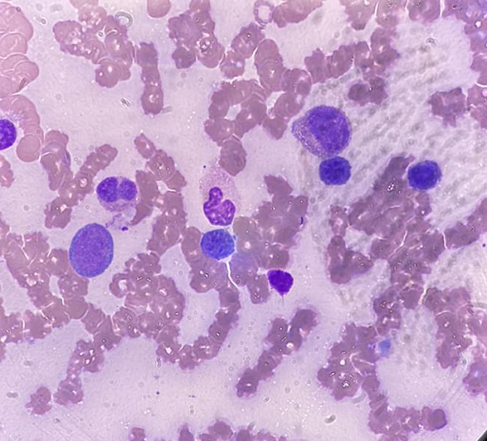 Bone marrow biopsy, hematoxylin and eosin staining, power of magnification x400, showing cellular marrow with increased megakaryocytic and prominent erythropoiesis with normal granulopoiesis