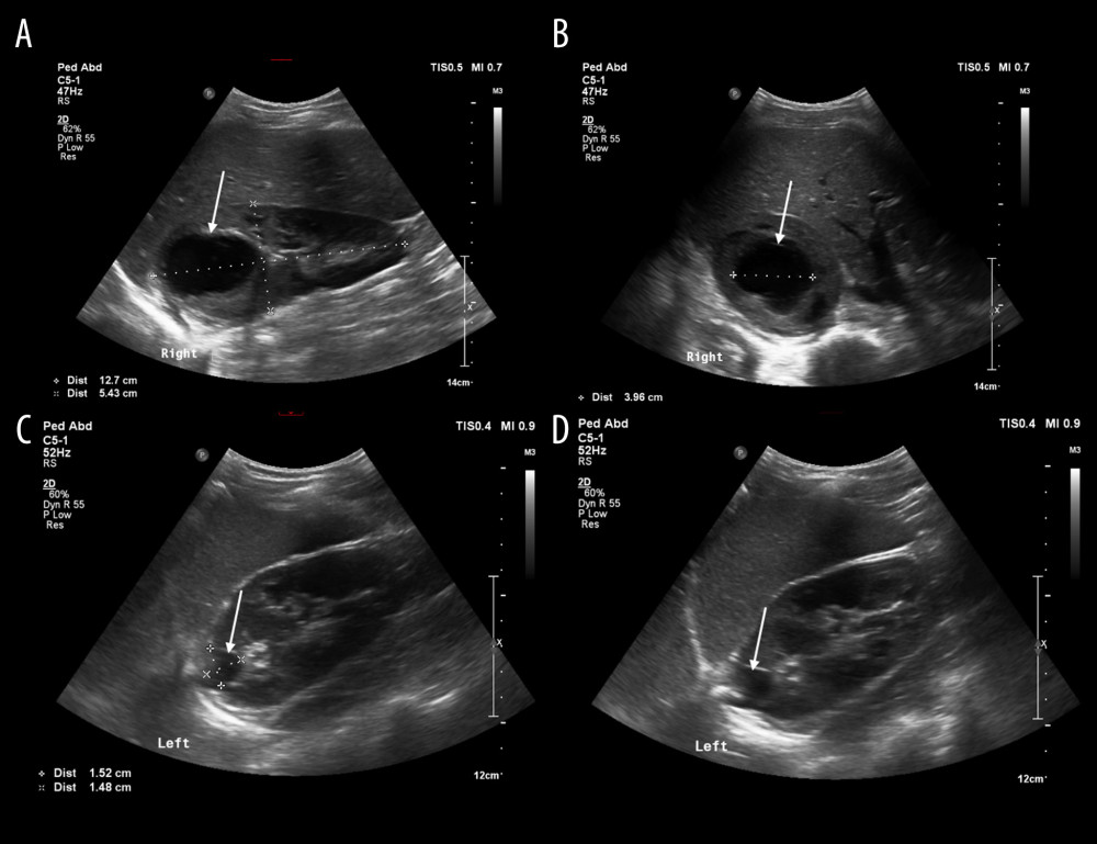 Abdominal ultrasonographic images. (A, B) The solid white arrow indicates a 49×38×45-mm irregularly shaped multilocular cystic lesion with thick wall and lobed surface involving the renal parenchyma but not including the urinary system in the upper pole of the right kidney. (C, D) The solid white arrow shows a 17×20×15-mm simplex cyst at the edge of the parenchyma in the upper third of the left kidney.