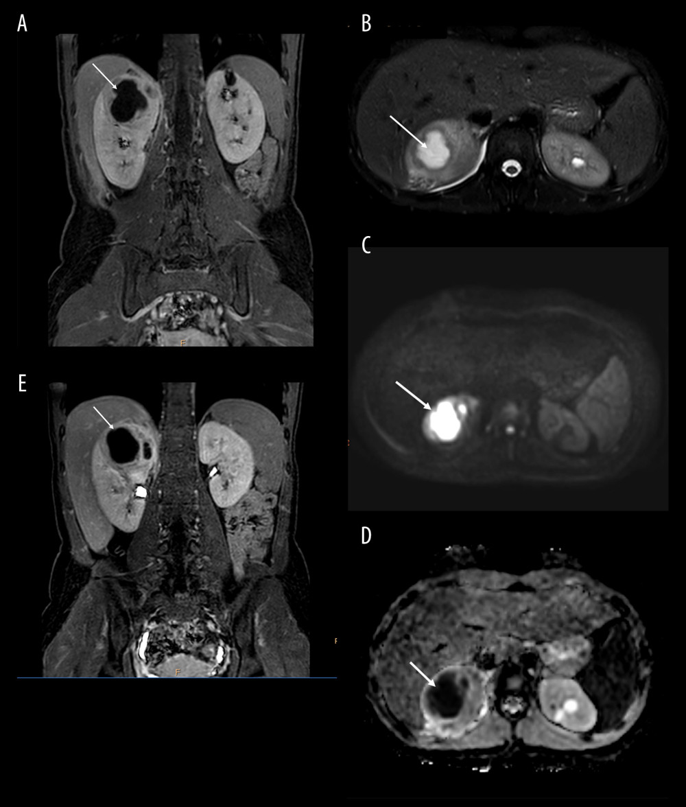 MRI images of pediatric renal abscess and cysts. (A) On the coronal TI-weighted, contrast-enhanced image the abscess and the cysts cannot be differentiated. (B) On the axial T2-weighted image, high signal intensity can be seen in each fluid-containing mass. (C, D) Information about the nature of the contents can be obtained by comparing diffusion-weighted imagining (DWI) and apparent diffusion coefficient (ADC) measurements: on the DWI series abscess in the right kidney has high signal and low ADC indicating restricted diffusion, while the cysts in the left kidney with clear fluid content have low signal on DWI with high signal on ACD. These measurements suggest that the lesion in the right kidney is an abscess. (E) Coronal magnetic resonance urography measurement was performed, proving that the abscess and cysts were not involving the urinary tract, as the contrast agent was not visible in any of the lesions. The solid white arrows indicate the abscess, the solid white five-pointed stars show the cysts. MRI – magnetic resonance imaging; T1W – T1-weighted; T2W – T2-weighted; DWI – diffusion-weighted imagining; ADC – apparent diffusion coefficient.