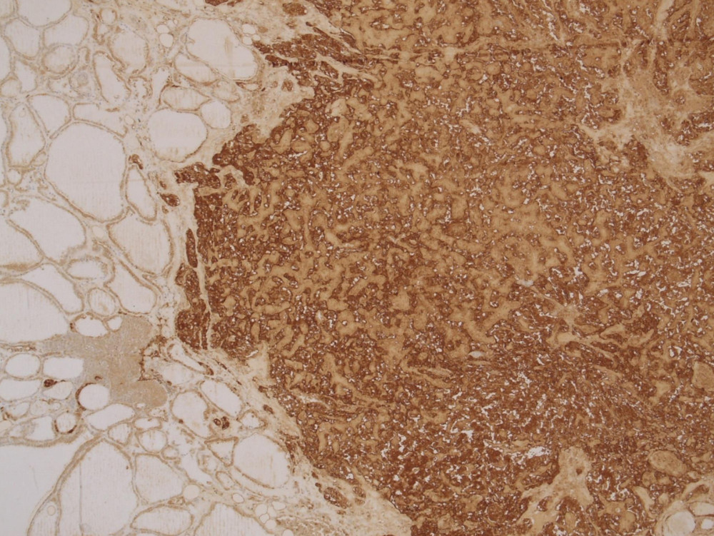 Intense immunohistochemical staining of tumor cells for calcitonin. IHC of a histologic section of Ct-negative medullary thyroid carcinoma stained with anti-calcitonin antibody.