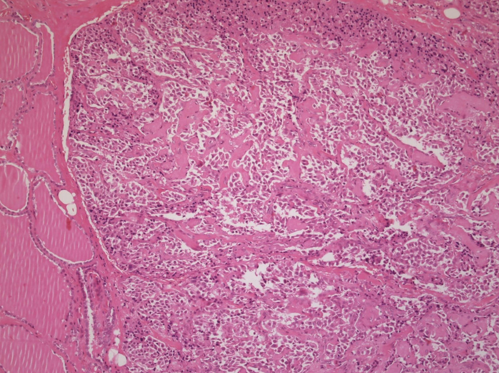 Transection of MTC. Histologic section of medullary thyroid carcinoma characterized by dense bands of fibrous tissue (black arrow) and trabecular or sheetlike growth pattern (red arrow). Cells appear round, polygonal, or spindle-shaped. The cytoplasm is eosinophilic and finely granular (blue circle).