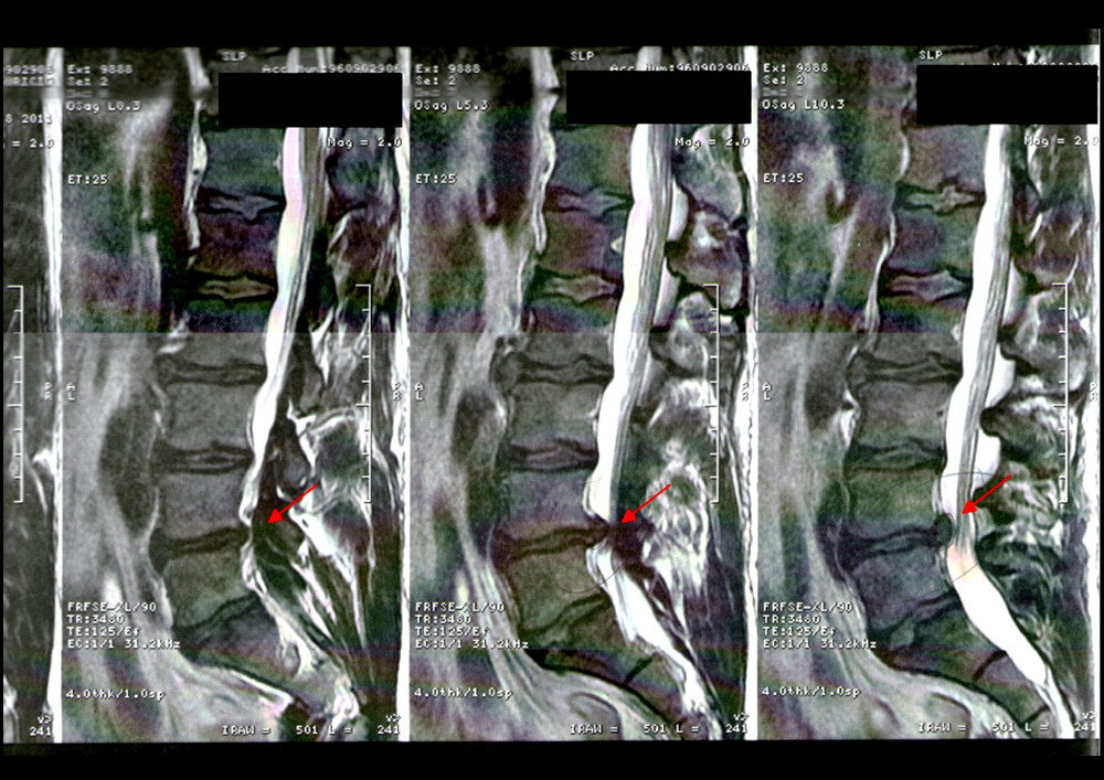 Lateral MRI view of the lumbar spine showing disc extrusion at L4–L5 level prior to Atlasprofilax treatment. The red arrows in this MRI show an extrusion of the intervertebral disc at the L4–L5 level prior to the treatment with the Atlasprofilax method, after which a rectification of the lumbar spine from L1 to L5 is evidenced.