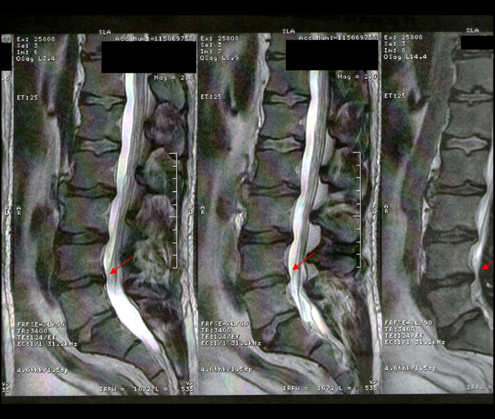 Lateral MRI view of the lumbar spine 6 months after Atlasprofilax treatment, showing disc extrusion reabsorption at L4–L5 level. The red arrows in this MRI show the regression of the intervertebral disc extrusion at the L4–L5 level. After treatment with the Atlasprofilax method, the rectification of the lumbar spine continues from L1 to L5.