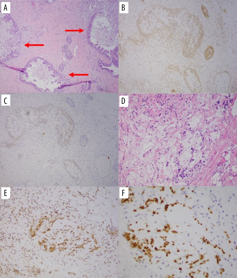 (A–C): H&E stain (10×) of pancreatic tissue (A) showing well-defined malignant glands (arrows). A loss of expression of DPC4 revealed by immunohistochemistry stain (10×) in (B) and weak to absent nuclear expression on CDX1 immunohistochemistry (10×) in (C) confirmed a diagnosis of pancreatic adenocarcinoma. (D–F): (D) H&E stain (20×) of gastric antral tissue showing poorly differentiated adenocarcinoma with signet ring features. (E) DPC4 immunohistochemistry stain (20×) and (F) CDX2 immunohistochemistry stain (20×) showing intact nuclear expression within the gastric carcinoma.