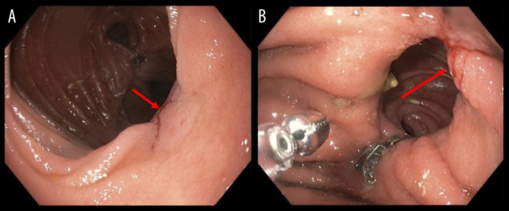 (A) Area of erosion (arrow) seen proximal to the gastrojejunostomy junction. (B) Biopsy taken from the area resulting in minor bleeding (arrow).