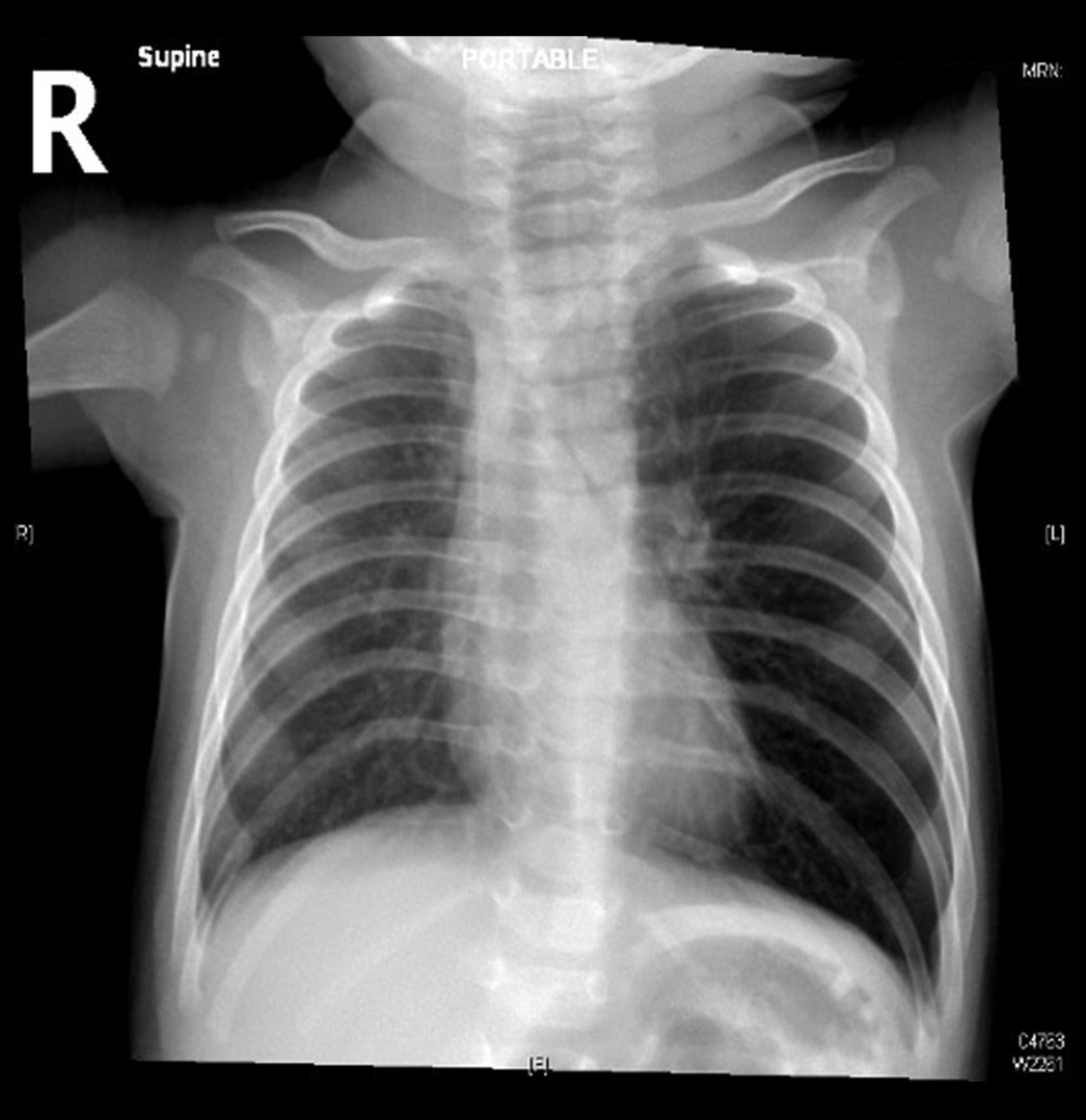 Plain chest X-ray, anteroposterior view, showing bilateral hyperinflation more on left side with marked attenuated blood vessels obvious on left side, depressed hemidiaphragm on left side, and tubular heart-like appearance.