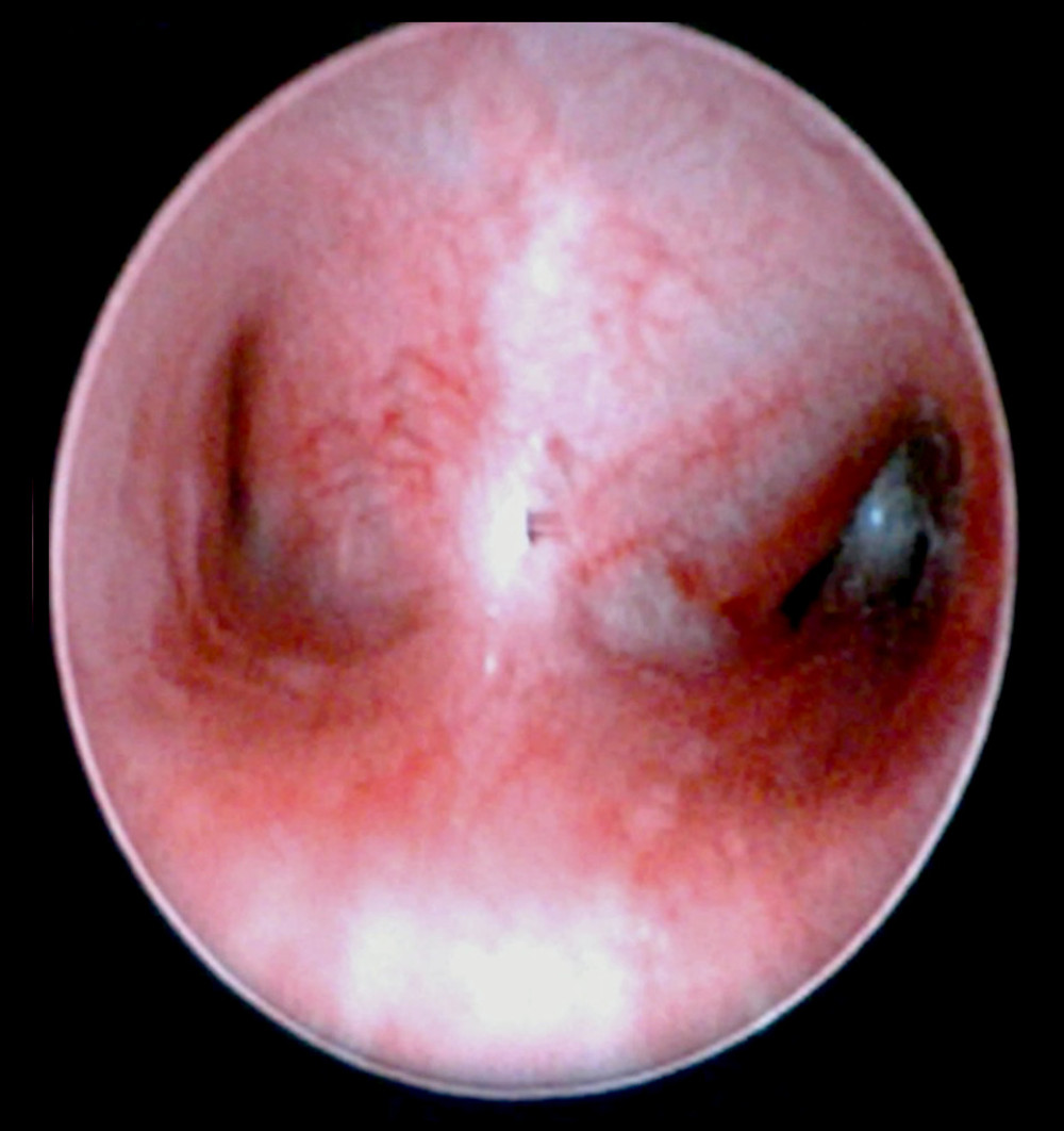 Flexible bronchoscopy picture, showing blunted shape of the carina, with apparent subcarinal external compression, more obvious on left main bronchus with healthy-appearing mucosa.
