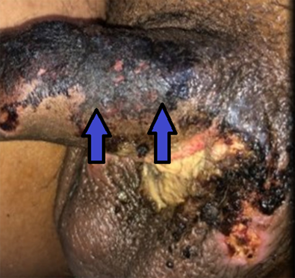 Stellate purpura with necrosis of the dorsum of the penis, lateral view (blue arrows).