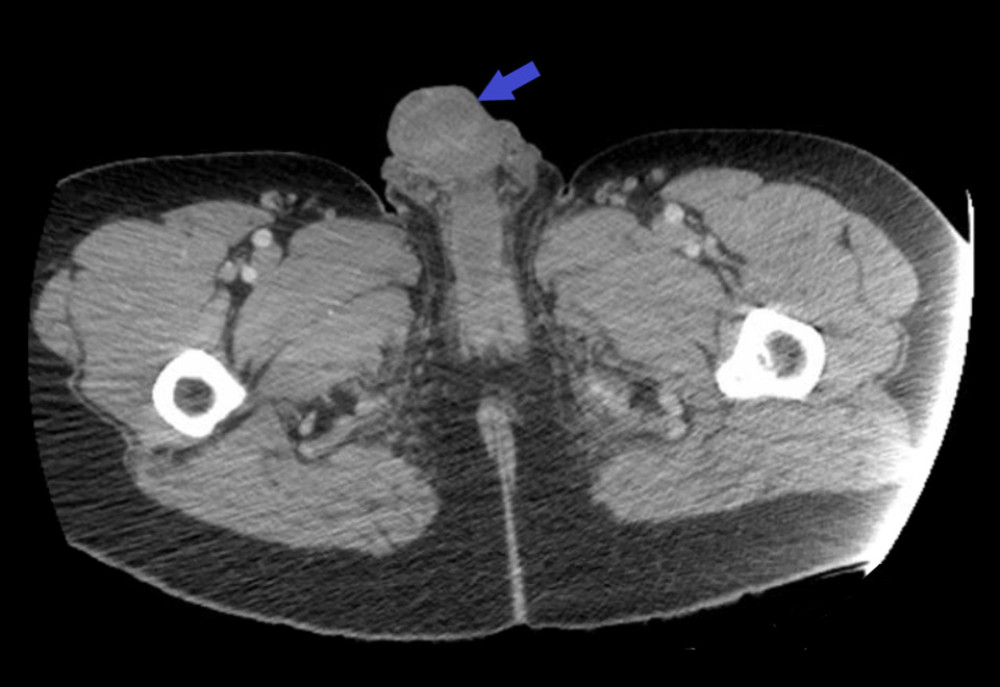 Computed tomography of the pelvis performed with contrast showed subcutaneous edema of the penis with ulceration of the penile tip on the right (blue arrow).