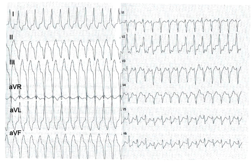 12-lead electrocardiogram during ventricular tachycardia. A clinical electrophysiologist noticed that the arrhythmia did not have the typical morphology for idiopathic left ventricular tachycardia (more precisely, left posterior fascicular ventricular tachycardia) mainly due to inconsistent R-wave amplitude differences between adjacent leads (ie, amplitudes in leads: V1 – low, V2 – high, V3 – low, V4 – residual, V5- high). Such a pattern might suggest scar-dependent ventricular tachycardia, but this requires confirmation.