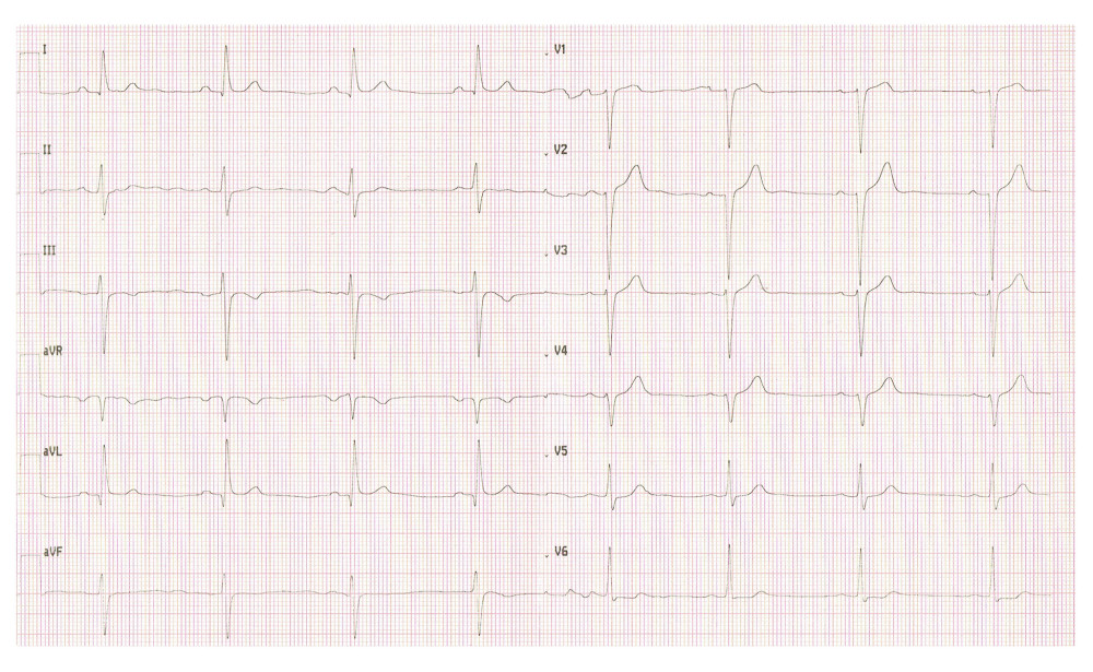Resting ECG. Sinus bradycardia 50 bpm, lack of R wave progression V1–4, and non-specific repolarization abnormalities with QTc 380 ms are apparent.