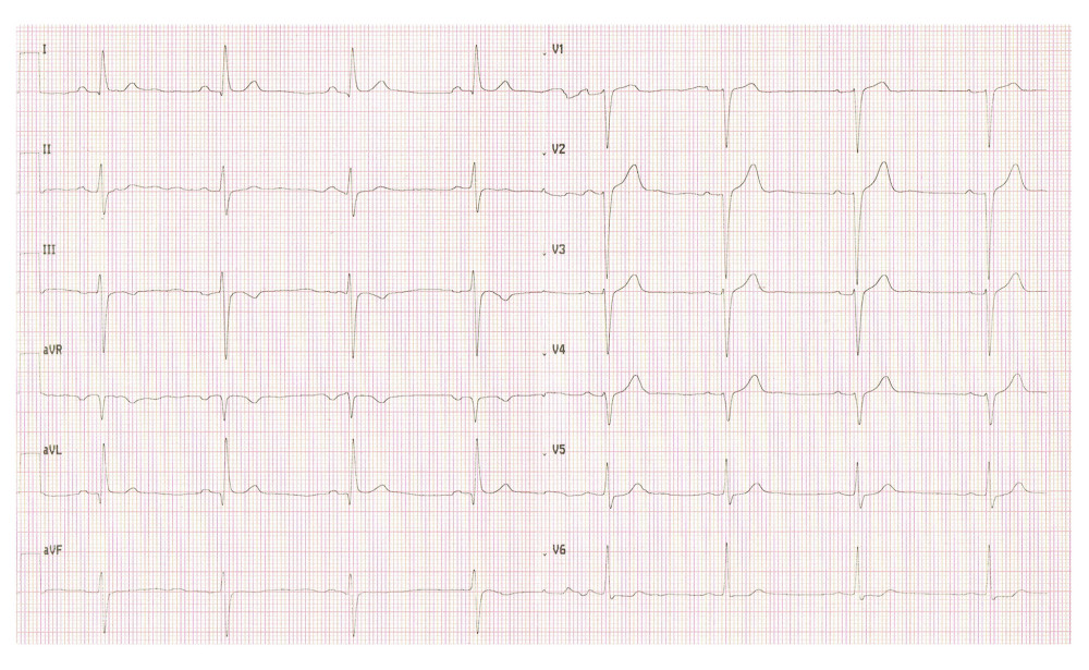 Resting ECG. Sinus bradycardia 50 bpm, lack of R wave progression V1–4, and non-specific repolarization abnormalities with QTc 380 ms are apparent.