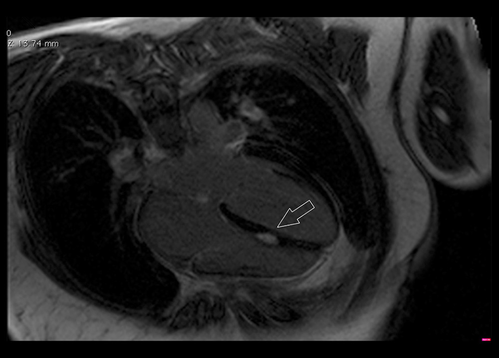 Initial cardiac magnetic resonance imaging (MRI). Tumorous enhancement detected by cardiac MRI in interventricular septum is indicated by the arrow.