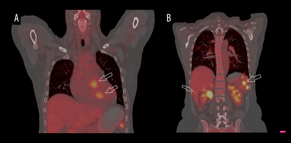 Whole-body 18F-fluorodeoxyglucose uptake on initial positron emission tomography scan. Foci of increased metabolism were found in (A) heart (indicated by arrows) and (B) lungs, spleen, and liver (indicated by arrows).