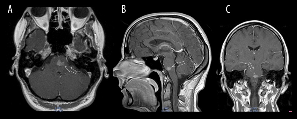 Initial brain magnetic resonance imaging. Scans of transverse plane (A); sagittal plane (B), and coronal plane (C) are shown. The lesion in the central part of the pons is indicated by the arrows.