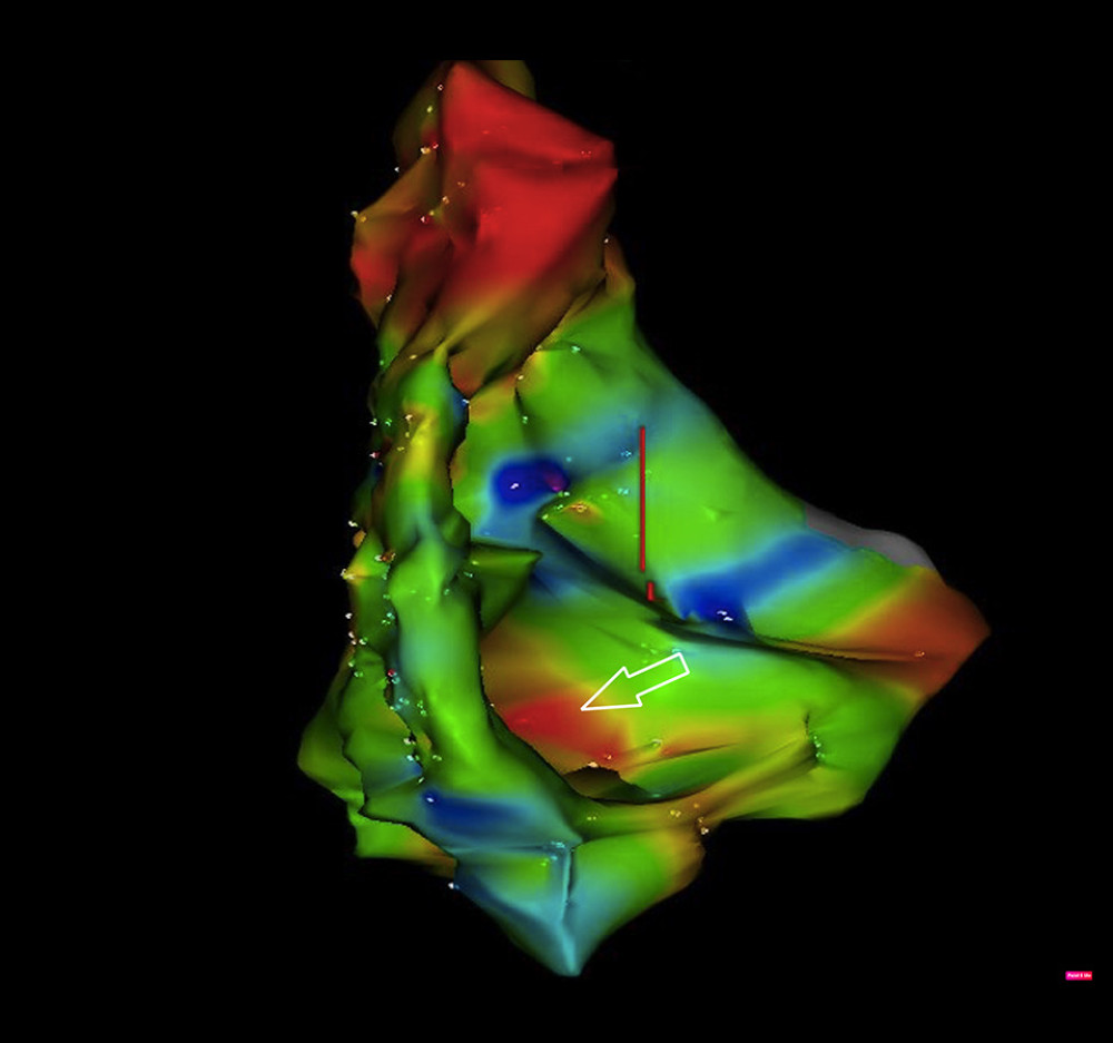 Intraprocedural 3D electrophysiological map created during endomyocardial biopsy. The low-voltage (red) area corresponding to the interventricular septum tumor is indicated by the arrow.