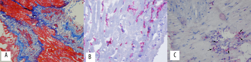 Histological examination of the biopsy specimen taken from the interventricular tumor. (A) Masson trichrome stain of the cryostat section demonstrates extensive fibrosis with myocyte necrosis (blue color). Original magnification: 200×; (B) Strong upregulation of HLA class II (DR) expression in the cryostat biopsy sections (red color). Original magnification: 200×. (C) Inflammatory cell infiltration with CD45-positive cells (arrows) is present. Original magnification: 200×.