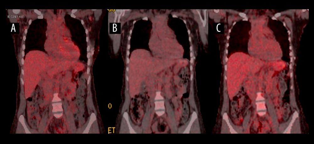 18F-FDG-PET/CT imaging. Scans in a similar plane. (A) After 4 weeks of antibiotic therapy; (B) After 3 months post-antibiotic therapy; (C) After 24 months post-antibiotic therapy.