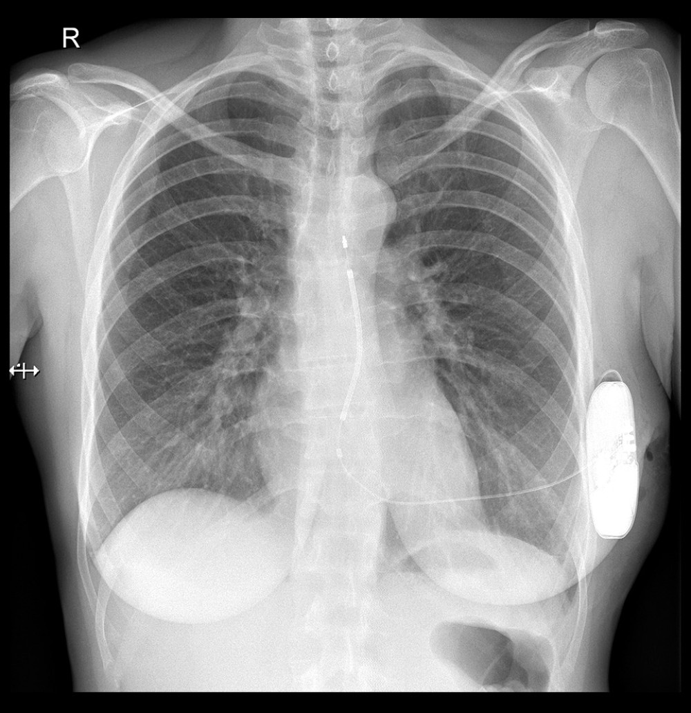 Chest X-ray (posteroanterior view) after subcutaneous cardioverter-defibrillator implantation.