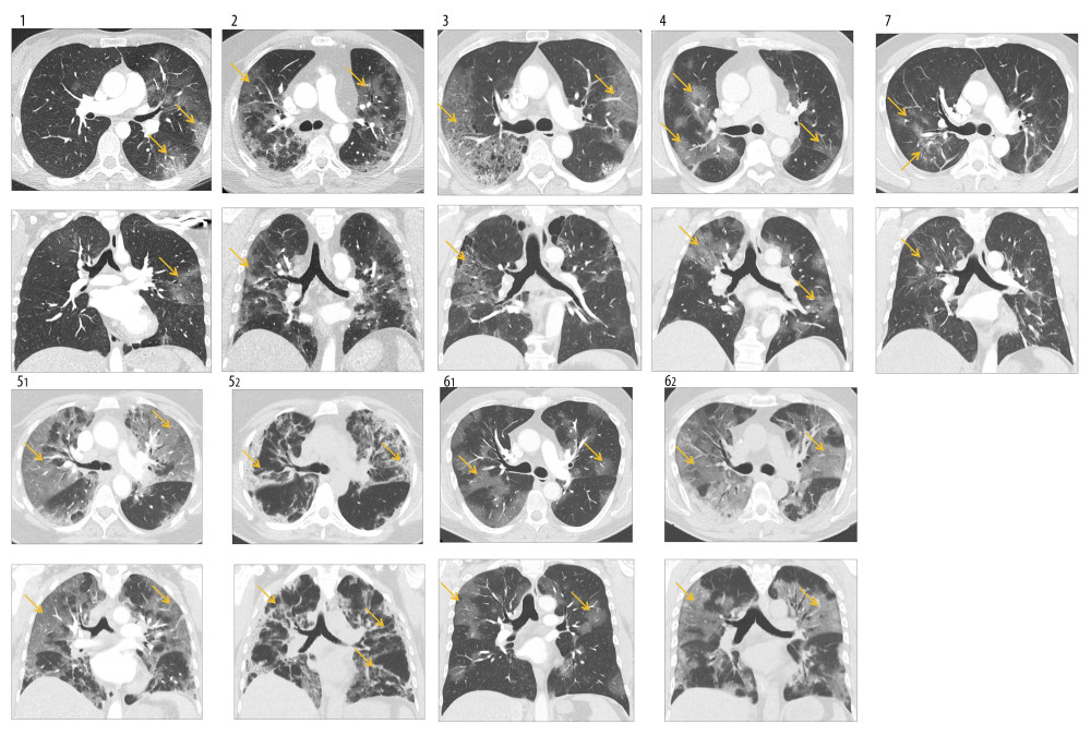 (1–7) CT scans during hospital stay. Chest CT scans (Contrast spiral-CT; axial [above] and coronal [below] plane) on admission showed bilateral infiltrates, predominant basal distribution, and development of fibrosing alveolitis in all patients (yellow arrows). Patients 5 (and 6) received a second CT scan (52/62) on day 11 (and 8), showing peripheral lung consolidation interpreted as bacterial superinfection by our local radiologist.