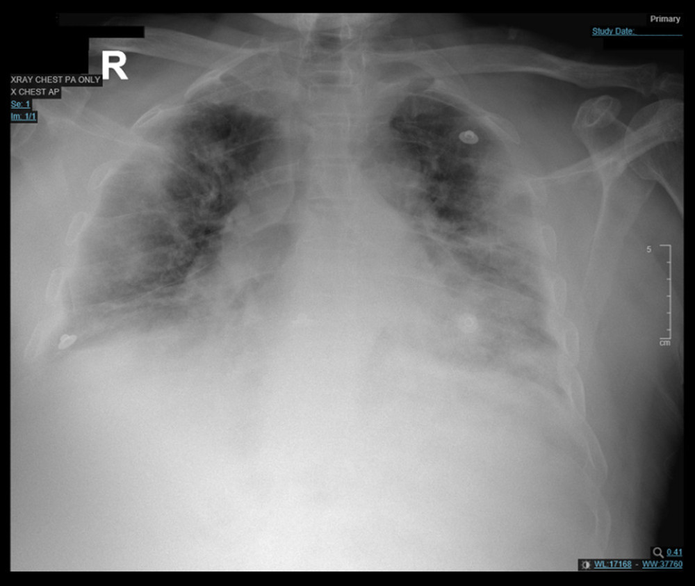 Confirmed case of COVID-19 in a 41-year-old man with an anterior-posterior chest X-ray showing diffuse bilateral patchy infiltrate.