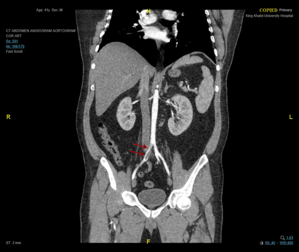 CT abdomen angio-aortogram, coronal view, demonstrating a filling defect with total occlusion of the right common iliac artery.