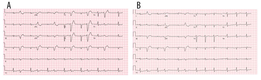 (A) The patient’s electrocardiogram (EKG) showing junctional rhythm with ventricular bigeminy, both commonly seen findings in digoxin toxicity. (B) EKG 1 h after administration of digoxin immune fab: EKG exhibits atrial fibrillation with multiple premature ventricular contractions, the most noted EKG finding in digoxin toxicity.