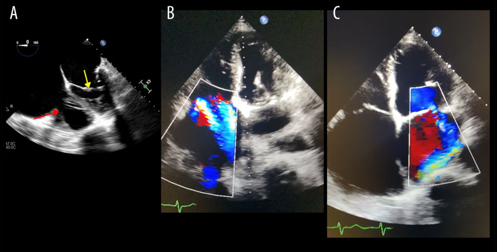 A transesophageal echocardiogram with findings of (A) a mitral valve vegetation (yellow arrow) measuring 1.2×0.7 cm with severe eccentric mitral valve and moderate to severe aortic stenosis (red arrow). (B) Apical 4-chamber view of severe eccentric mitral regurgitant jet as visualized utilizing color Doppler. (C) Apical 4-chamber view of severe eccentric tricuspid regurgitant jet as visualized utilizing color Doppler.