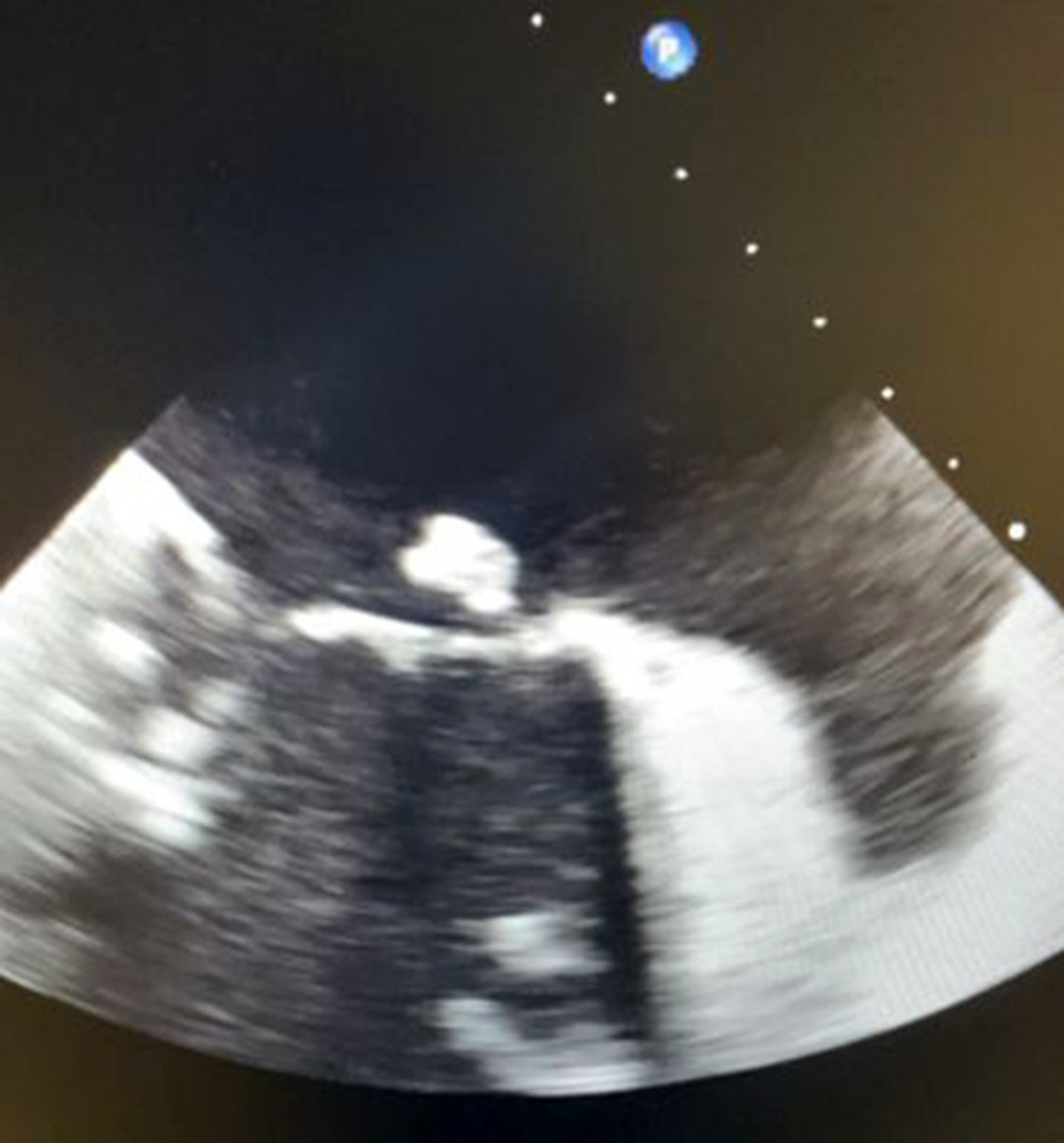 Transesophageal echocardiogram image with visualization of vegetation, estimated to measure 1.2×0.7 cm, attached to ventricular surface of posterior leaflet of the mitral valve.