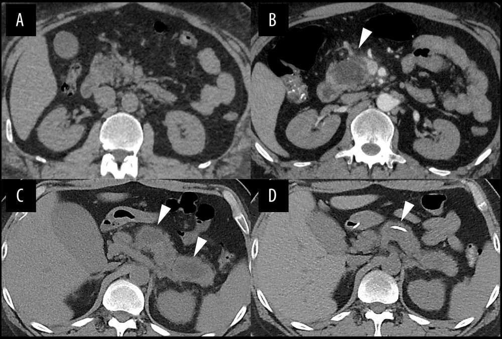 (A) Unenhanced computed tomography (CT) image on admission. (B) Contrast-enhanced CT on day 6. Focal enlargement of the pancreas and non-enhanced area within the pancreatic head is observed (arrowhead). (C) Unenhanced CT image on day 35. The main pancreatic duct is dilated (arrowheads). (D) Unenhanced CT image on day 44 shows reduction of the cystic lesion and main pancreatic duct dilatation following nasopancreatic drainage tube placement (arrowhead).