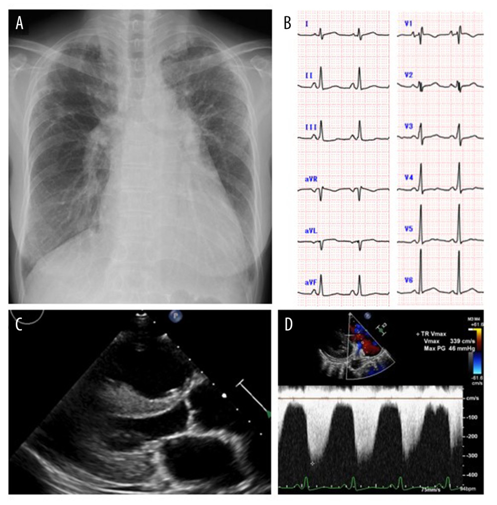 (A) Chest radiograph showing cardiomegaly and congested lungs. (B) Twelve-lead electrocardiogram showing sinus rhythm and RSR’ pattern in V1. (C) Echocardiogram in the parasternal long-axis view. The size of the right ventricle was enlarged. (D) Continuous color Doppler image of tricuspid regurgitation with an estimated right ventricular pressure of 49 mmHg.
