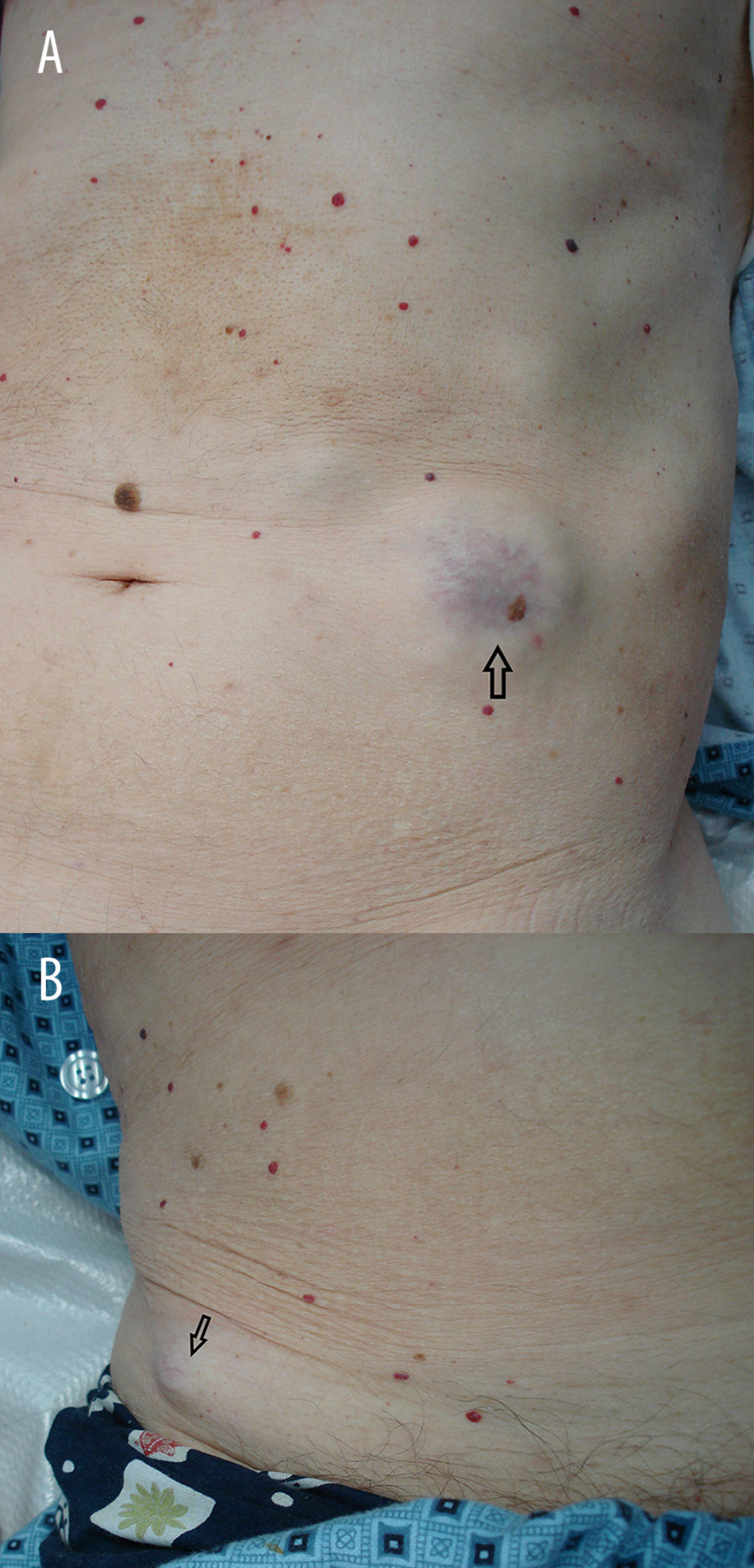 (A, B) The skin lesions on the left lumbar region and on the right iliac region.