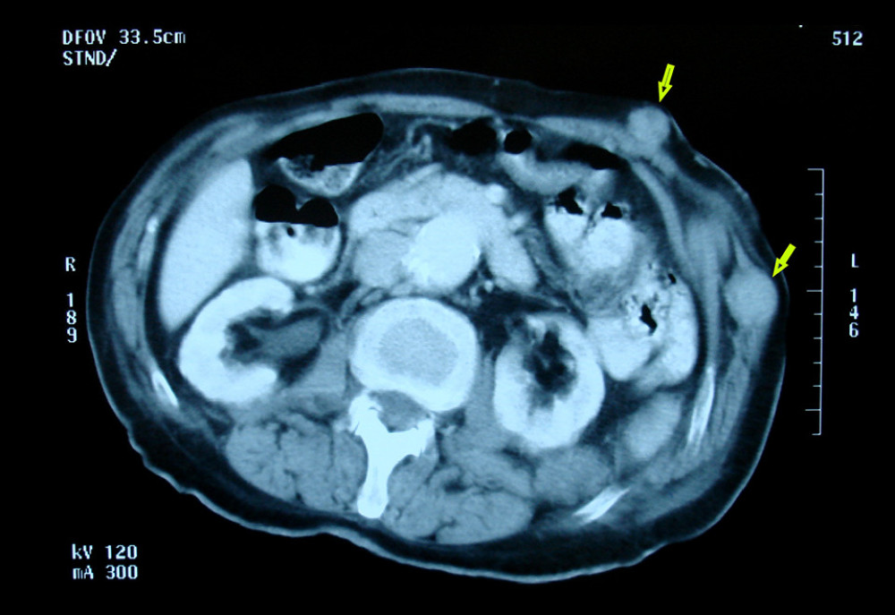 CT scan revealed multiple subcutaneous nodular lesions in the abdominal region.