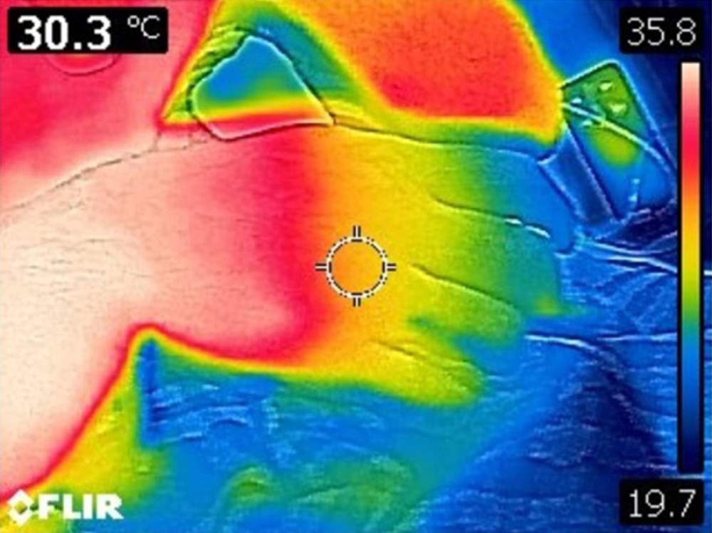 Infrared thermography of the hand. A critical temperature decrease of the fingers (in blue) was observed.