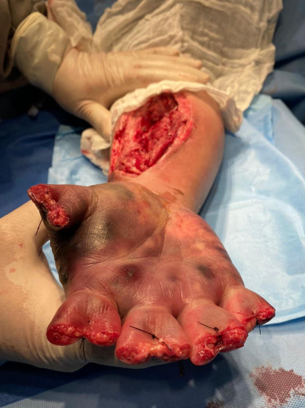 Debridement of dead tissue from previous fasciotomy and finger amputation.