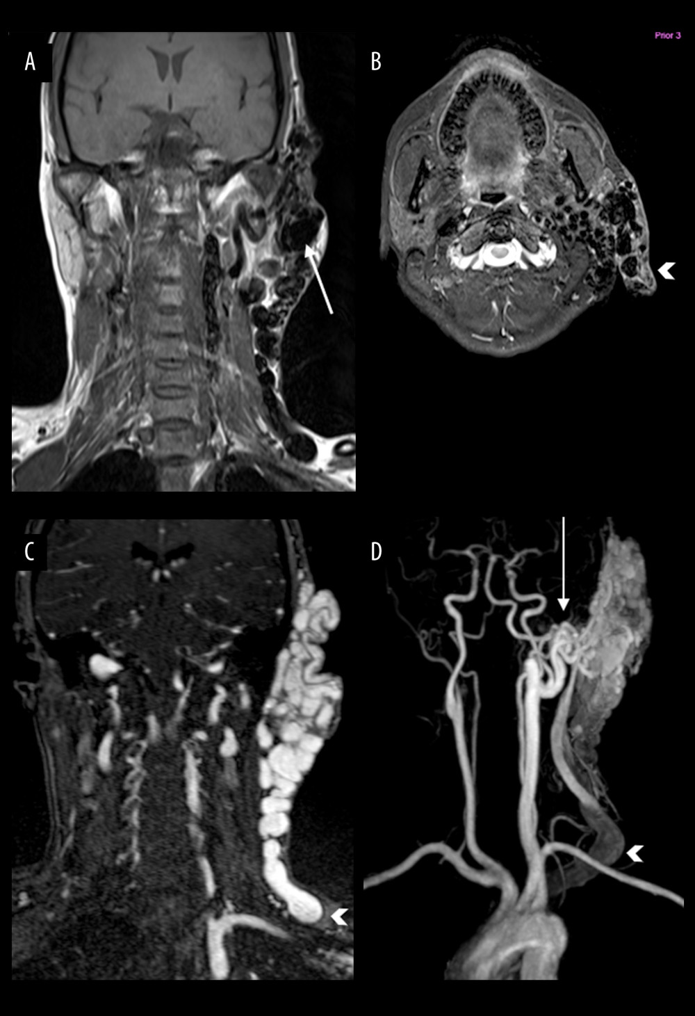 Coronal T1-weighted (A) and axial T2-weighted (B) MRI neck images of a 40-year-old woman show “bag of worms” or tangle of serpiginous “honeycomb” flow voids in the left parotid gland and left auricle (arrowhead, B) indicating an extensive high-flow arteriovenous malformation (AVM). An intranidal aneurysm (arrow, A) is present within the AVM. Coronal contrast-enhanced (CE) MRA image (C) shows the dilated and serpiginous vessels within the left parotid and auricular AVM and dilated veins draining blood into the left external jugular vein (arrowhead). Maximum-intensity projection of CE-MRA image (D) shows the left posterior auricular artery (arrow), one of the main arterial blood supplies to the AVM, along with the superficial temporal artery. These 2 are branches of the left external carotid artery (arrow). The AVM drains predominantly into a dilated and serpiginous left external jugular vein (arrowhead).