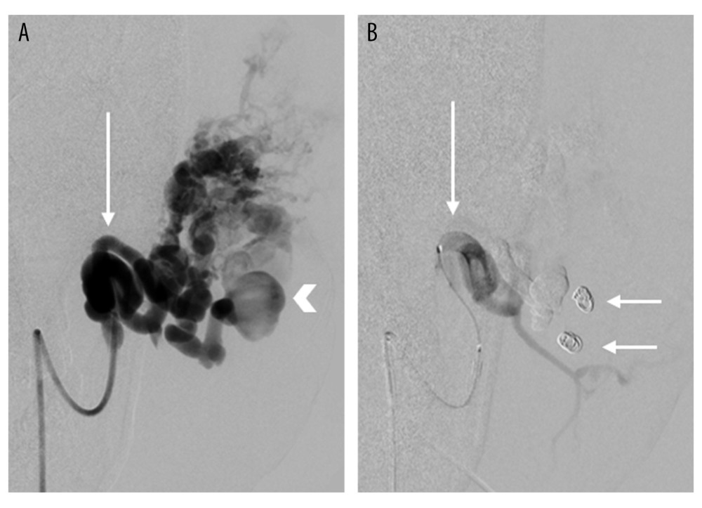 Conventional catheter angiogram (A) with the catheter tip within the posterior auricular branch (arrow) of the left external carotid artery. There is opacification of the dilated vessels and intranidal aneurysm (arrowhead) within the AVM. The post-embolization angiogram (B) shows successful embolization of the AVM with a combination of coils (short arrows) and diluted mixture of (25%) Histoacryl in Ethiodol. There is a marked decrease in vascularity of the AVM and occlusion of the intranidal aneurysm.
