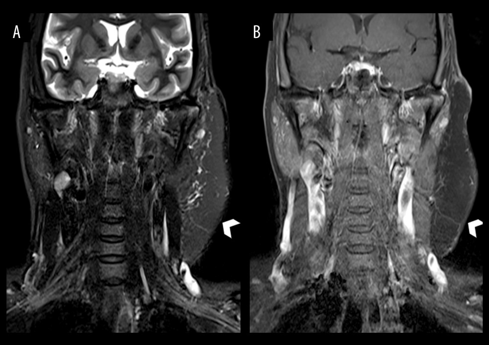 Coronal T2-weighted (A) and T1-weighted post-contrast (B) MRI neck images of the patient about 6 months after left parotidectomy and left total auriculectomy. An intact musculocutaneous flap is present in situ (arrowhead). There is no remnant or recurrent AVM.