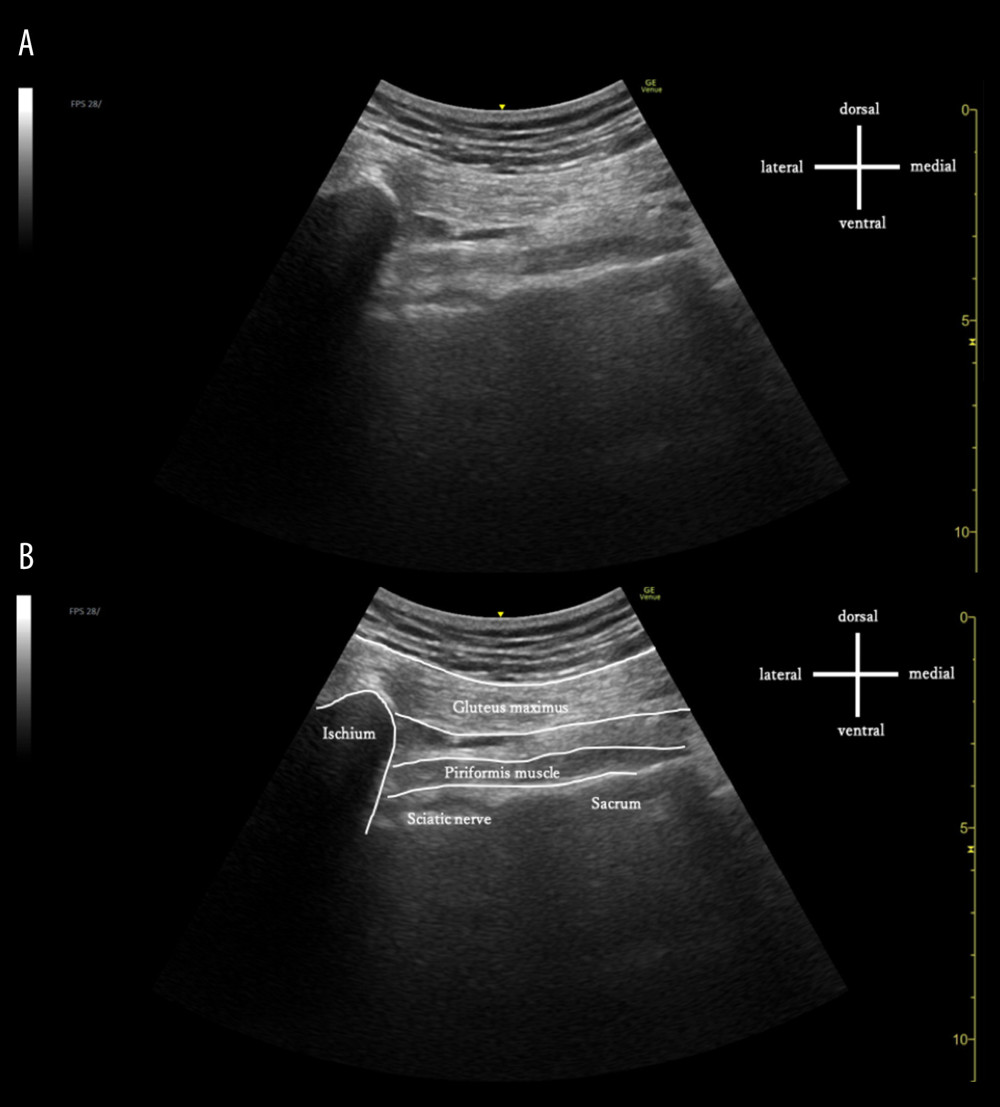 Ultrasound image before injection.