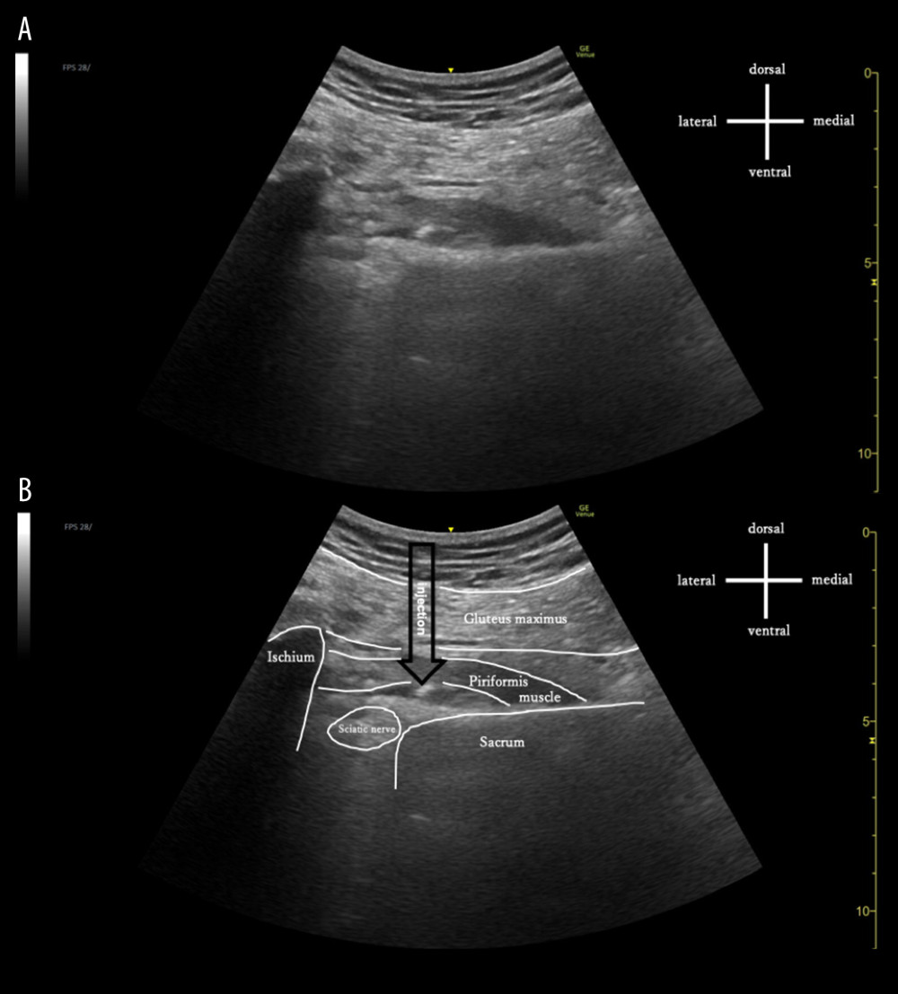 Ultrasound image during injection.