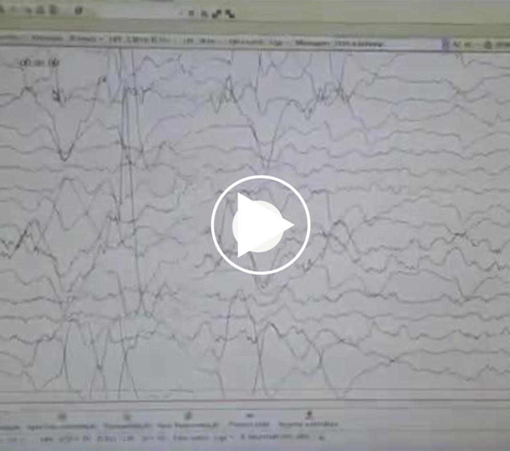 Electroencephalography during events in patient 2, showing no specific epileptic activity.