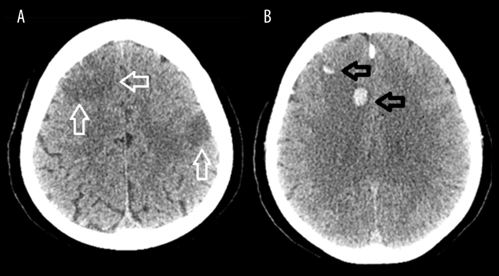(A) Axial section of CT scan of the head shows hypodensities (white arrows) in right frontal, parietal, and left parietal regions, (B) multiple hemorrhagic foci noted (black arrows) in right frontal region.