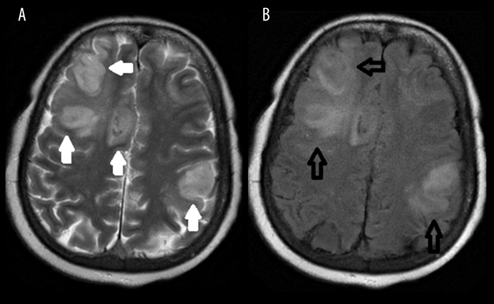 (A) T2-weighted image in axial section showing infarcts (solid white arrows) in right frontal and left parietal region, (B) T2-weighted FLAIR sequence showing infarcts (black arrows) in the above regions along with hemorrhage in the right frontal region near the midline.