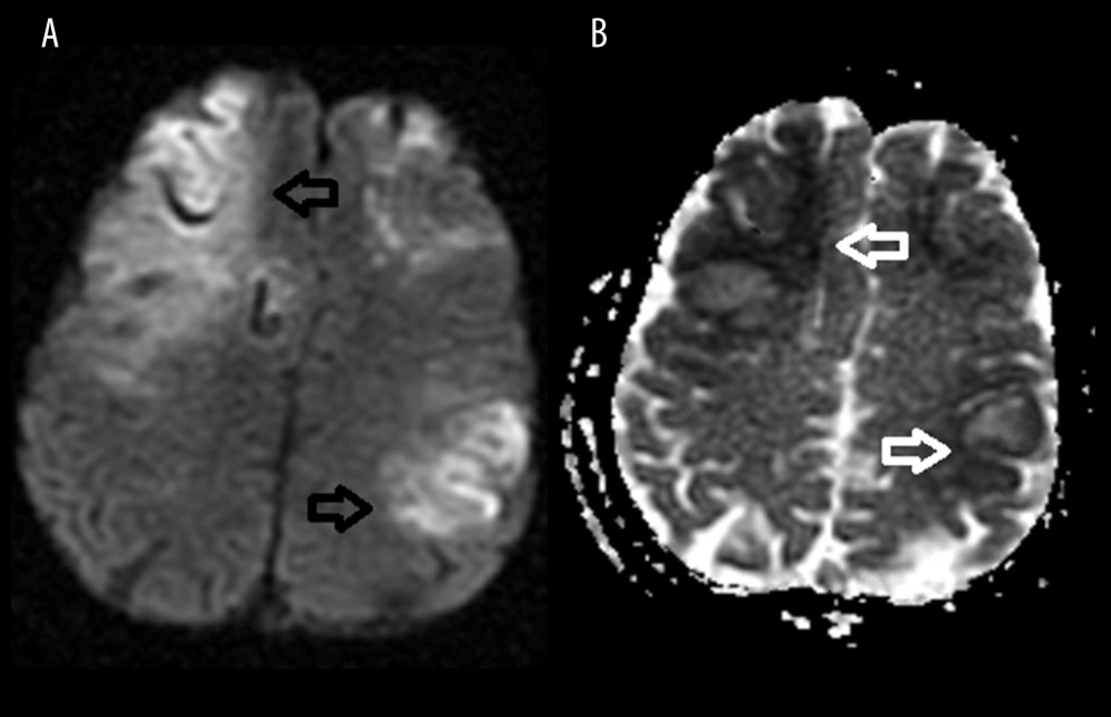 (A) Diffusion-weighted image showing areas of infarcts (black arrows) in right frontal and left parietal regions. (B) Corresponding ADC images showing regions of hemorrhages (white arrows).