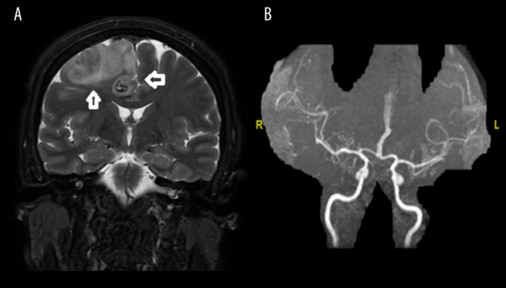 (A) Coronal section of T2-weighted MRI image shows infarct (white arrows) with areas of mosaic hemorrhage in right parietal region, (B) MR angiogram showing a patent arterial system.